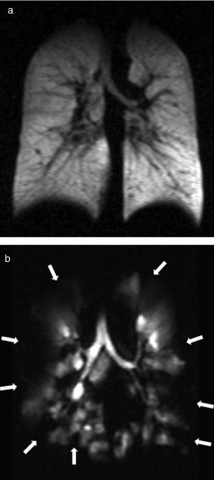 HP 3He MRI; coronal ventilation images. (a) Homogeneous distribution of signal in the pulmonary parenchyma in a healthy subject and (b) multiple ventilation defects in a COPD patient (arrows).
