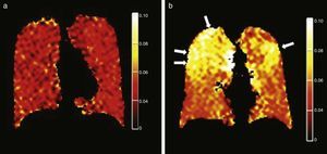 ADC maps with hyperpolarized 129Xe gas. (a) Normal patient. Low, homogeneous ADC values and (b) emphysematous patients. Heterogeneous maps with higher ADC values predominantly in the upper portions of lungs (arrows).
