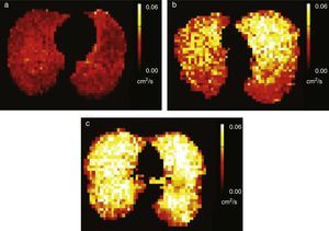 Alveolar enlargement in passive smokers. ADC maps with hyperpolarized 129Xe gas of three different subjects, (a) one non-smoker with little exposure to tobacco smoke, (b) one passive smoker with heavy exposure to smoke and (c) one smoker show progressively higher ADC values and consequently larger alveolar size.