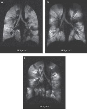 Ventilation defects in asthma. Coronal ventilation images with 3He in 3 asthmatic patients with decreasing percent values of forced expiratory volume: (a) 83%, (b) 47% and (c) 34%. Multiple bilateral ventilation defects can be seen in the three images rising progressively as the forced expiratory volume diminishes even present with a normal spirometry (a).