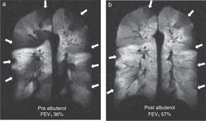 Coronal images of 3He ventilation in one asthmatic patient before and after therapy. (a) Before therapy. Great ventilation defects (arrows) and (b) after the administration of albuterol we can observe fewer defects (arrows) and some improvement in the spirometry.