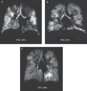 Ventilation defects in cystic fibrosis. Coronal ventilation 3He images in 3 patients with decreasing percent values of forced expiratory volume: (a) 50%, (b) 67% and (c) 89% show multiple bilateral ventilation defects regardless of spirometry results.