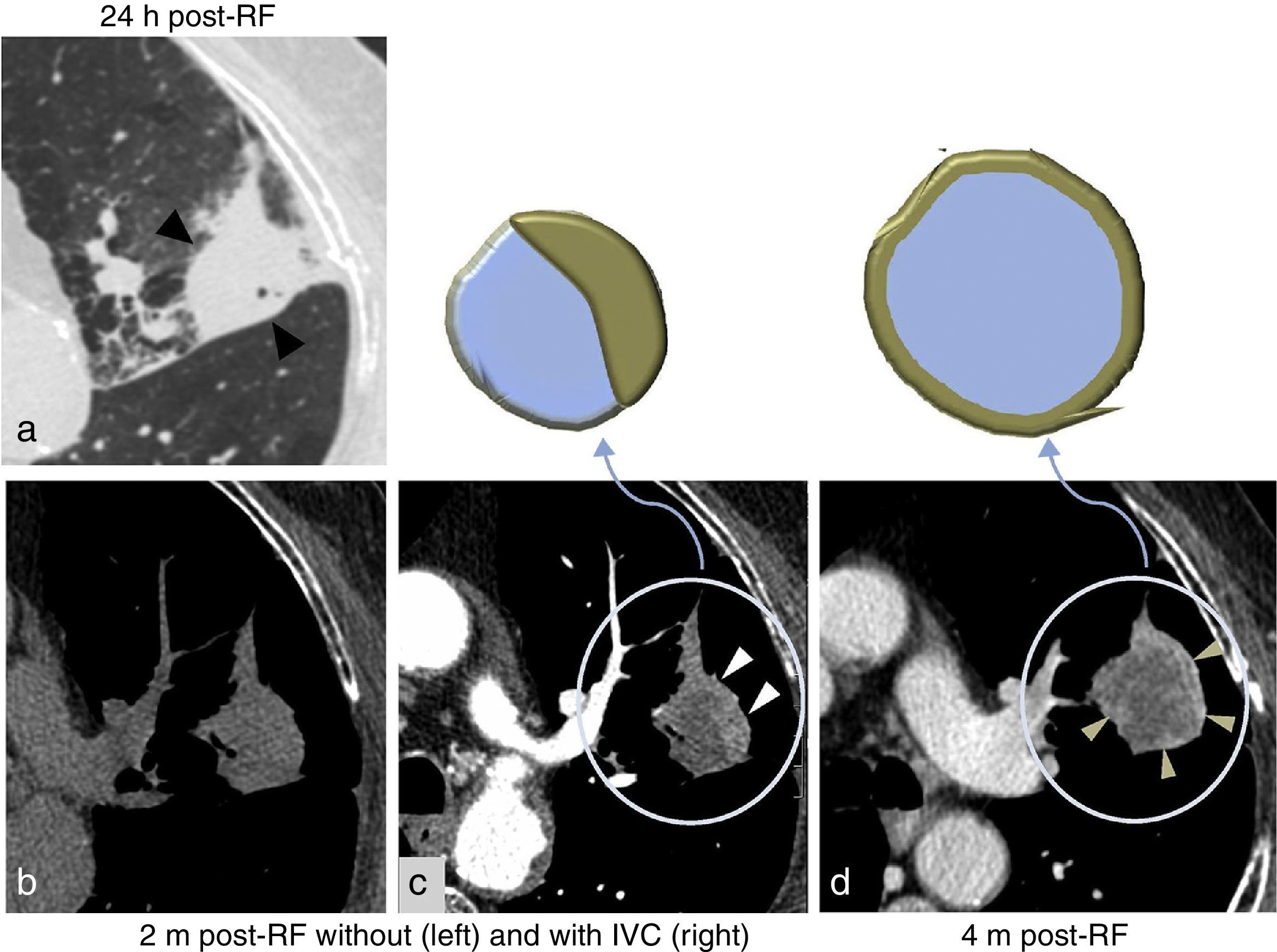 Pulmonary radiofrequency ablation (Part 2): Procedure and follow-up ...