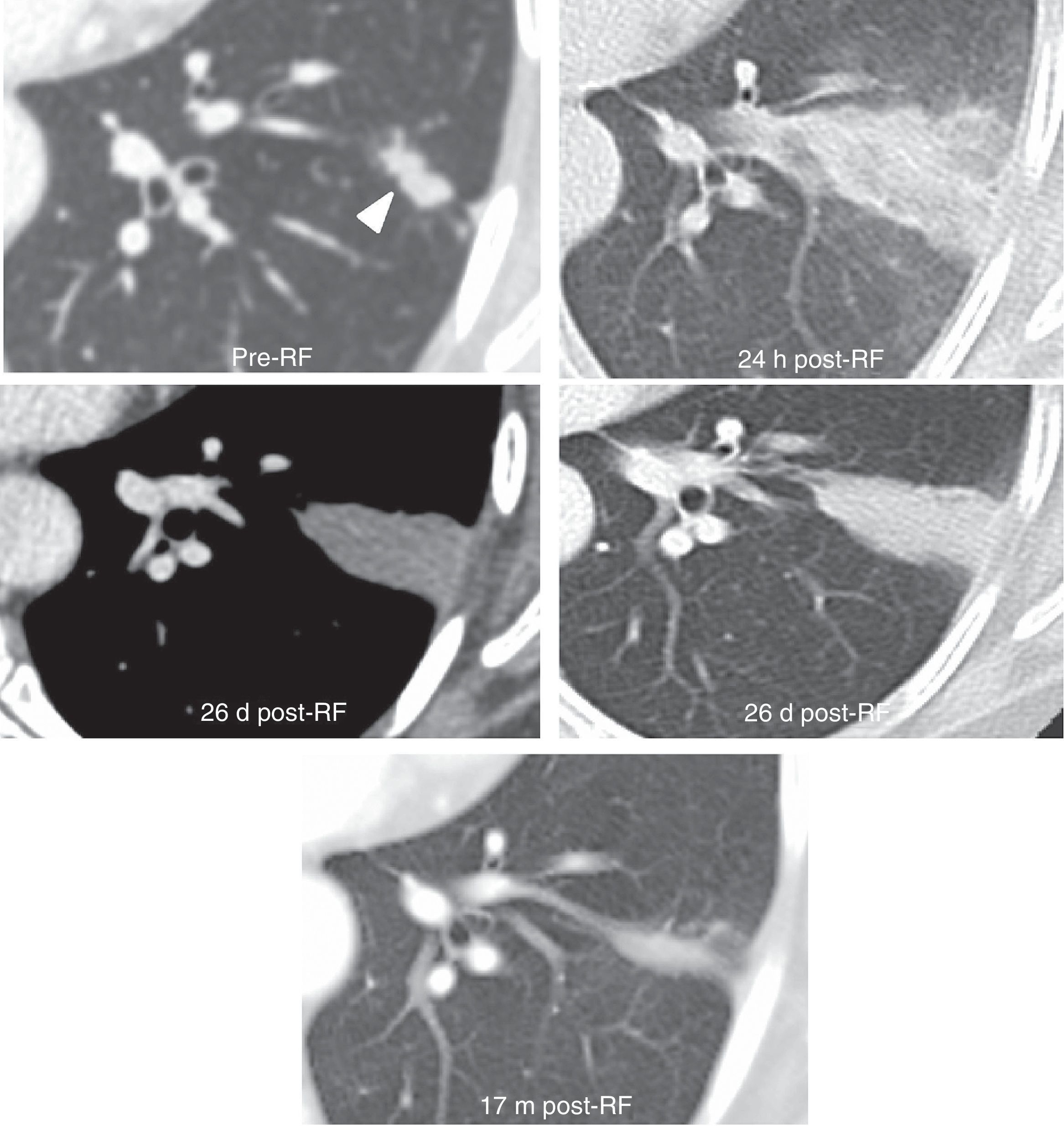 Pulmonary radiofrequency ablation (Part 2): Procedure and follow-up ...