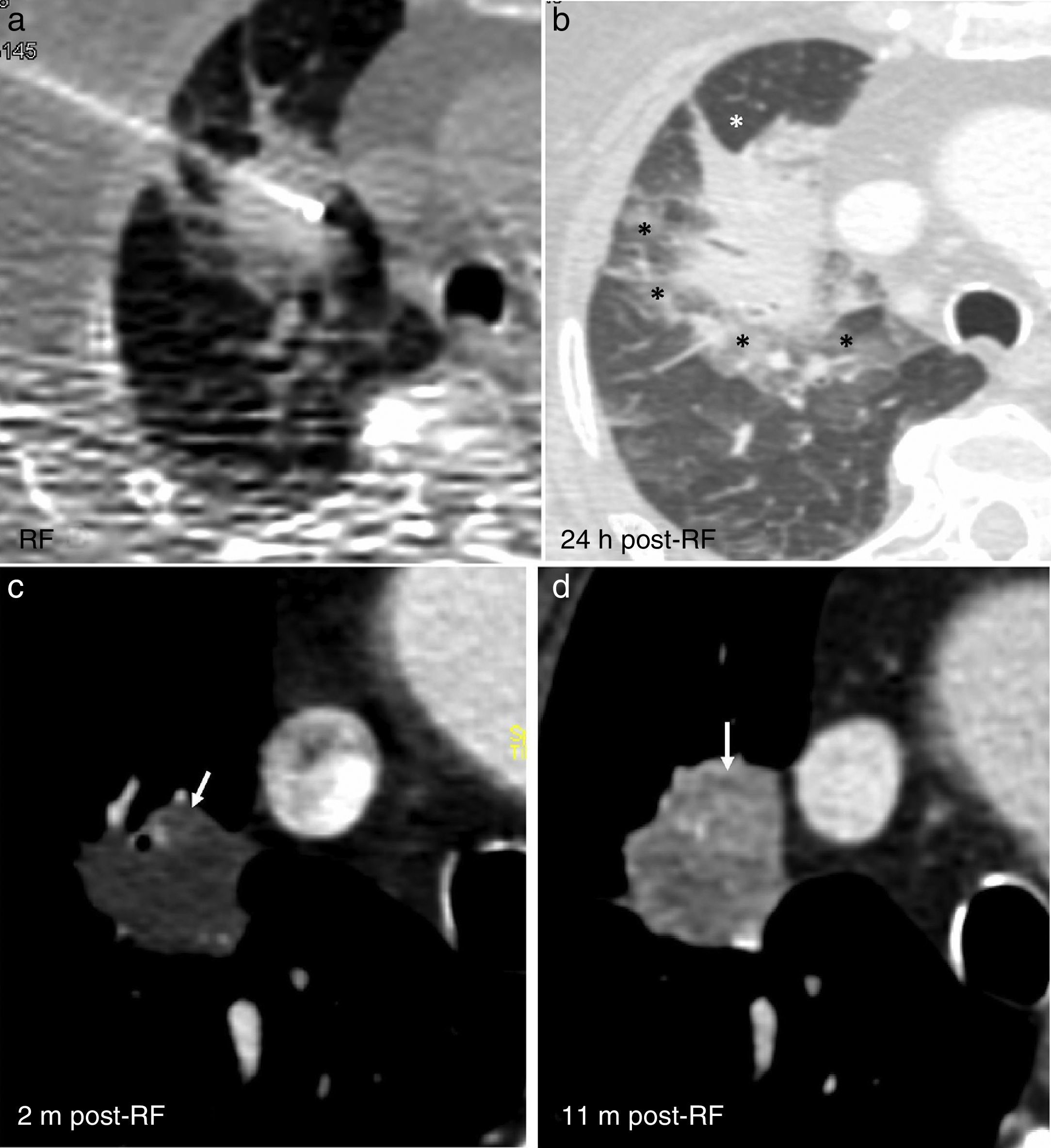 Pulmonary radiofrequency ablation (Part 2): Procedure and follow-up ...