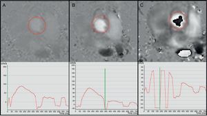 Effect of the speed selection in the phase contrast image in the aortic valve; 400m/s (A), 100m/s (B) and 50m/s speed sequences/images (C). With a very high speed selection (A) the sequence has a low signal and the curve is not very accurate. With an adequate speed selection (B), the ascending and descending flows can be easily identified and the curve shows adequate morphology and scale. If the speed selection is too low (C) then we are in the presence of aliasing and there is “descending” (black) flow in the aortic valve and a curve that cannot be interpreted with negative speed values in systole.