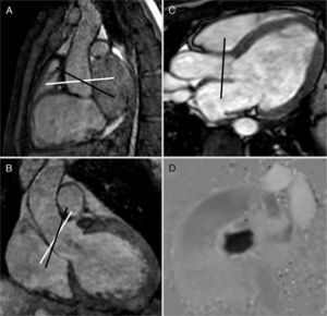 Steady-state images (3D-balanced FFE) in sagittal (A) and coronal (B) views; 2D-balanced image in a 3-chamber view (C) and phase image (D) of the aortic valve. The adequate planning takes place above the valve by placing the acquisition plane/view perpendicular to the direction of flow in two (2) orthogonal views (white lines in A and B). The 3-chamber view is used as the only reference and even though we can adequately see the valve the view will not be perpendicular to the flow (black lines in A and B), there will be an error of calculation in the speeds and therefore in the flow. Similarly this principle can be applied to all valves, vessels, and conduits.