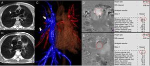 Patient with venous sinus type of intra-atrial communication (IAC) and anomalous pulmonary venous partial return of middle lobe and upper right return toward the superior cava. In the image of black blood in the axial view (A and B) one anomalous vessel can be seen entering the superior cava vein (arrow) as well as the IAC in a high position (arrow head). The anomalous pulmonary veins entering the cava vein (arrows) can be clearly seen in the processing of the contrast (C) angiography. The measurements of both the pulmonary (D) and aortic (E) flows were carried out multiplying the volume of ejection by the heart frequency (red circles). Qp=89.5cc/beat×94beat/min=8.413cc/min; Qs=27.1cc/beat×95beats/min=2.575cc/min; Qp/Qs=8.413/2.575=3.27.