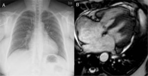 Fifty-two-year old patient with a late diagnosis of ostium secundum-type of IAC. (A) Cardiomegaly chest X-ray and larger caliber of pulmonary arteries suggestive of pulmonary hypertension. This finding should trigger all the alarms when it comes to the need for calculating the Qp/Qs before surgery. (B) Steady state image in a 4-chamber view/plane in ventricular systole showing a large IAC. The measurement of the Qp/Qs was 1.3–very low given the importance of the anatomic defect. Even though it is compatible with pulmonary hypertension this is not suggestive of shunt inversion (Eissenmenger syndrome).