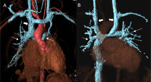 Processing images of angiography volumes through MRI in patients with systemic–pulmonary connection. In the patient with partial cavopulmonary connection or Glenn surgery (A) the superior cava vein (thick arrow) anastomoses with the right pulmonary artery (pulmonary arteries highlighted with thin arrows). The heart receives blood from the pulmonary veins and the inferior cava vein while working as a systemic pump only. After the total pulmonary connection or Fontan proceeding (B) the whole systemic venous circulation (except for the coronary sinus) directly irrigates the lungs through the cava veins. The patient has a double superior cava vein (thick white arrows) thus showing bidirectional Glenn anastomosis. The inferior cava vein connects to the right pulmonary artery through one duct (black arrow). The pulmonary artery (thin arrows) receives all its blood support from the systemic venous territory. The heart is still one systemic pump only but now getting the blood from the pulmonary veins.