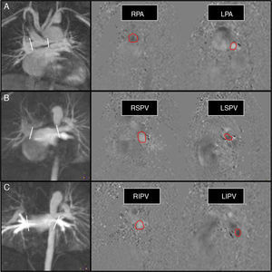 Shunt flow measurement shunt in univentricular surgery (Glenn partial cavopulmonary connection) in a 6-year old kid with left hypoplastic heart syndrome. Flow measurement in pulmonary arteries (A), superior pulmonary veins (B), and inferior pulmonary veins (C). In the angiographic images (left column) we can see the stenosis of the left pulmonary artery and the aortopulmonary collaterals stemming from the aortic arch and the descending aorta. The white lines show the position of the cut view in the planning of the phase contrast sequence/image over the angio-MRI. We obtained a total pulmonary flow in pulmonary veins of 2.2l/min, and a pulmonary flow across the pulmonary arteries of 1.5l/min; the shunt volume is therefore 0.7l/min. Please note how the direction of flow (and therefore its color in phase sequences) is reversed between left and right blood vessels and between veins and arteries. RPA: right pulmonary artery; LPA: left pulmonary artery; LIPV: left inferior pulmonary vein; RIPV: right inferior pulmonary vein; RSPV: right superior pulmonary vein; LSPV: left superior pulmonary vein.