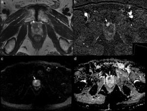 Multiparameter 3T MRI in a patient of 70 years with PSA of 6.3ng/ml and a transrectal ultrasound-guided biopsy previanegativa. The axial T2-weighted image shows a focal hypointense lesion (arrow in a) located on the right apicalanterior segment enhances PIRADS 4. The injury early in the subtraction image (arrow in b) and shows a delayed washing (graph b), PIRADS 5. the lesion is hyperintense on diffusion sequence, (b) value 1000 (arrow in c) and has a low coefficient dedifusión (arrow in d), PIRADS 5.