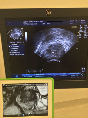 Relationship in the time of biopsy guiadacognitivamente between the image of the transrectal ultrasound. Convision longitudinal and sagittal T2-weighted image of multiparameter. Larm in an accessory screen. Focal hipointensa injured right middle peripheral gland (flechanegra) that is hypoechoic on ultrasound (white arrows).