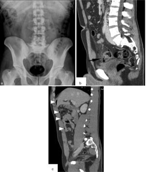 Thirty-four (34) year old male with pain in the lower semi-abdomen, fever and leukocytosis. (a) The AR of the abdomen in the decubitus supine position shows no significant alterations. (b and c) CT parasagittal images. Wall thickening of sigmoid colon with diverticula and perforation of one of these diverticula (arrow in b) with presence of extraluminal gas and signs of adjacent fat inflammation. Multiple bubbles of intraperitoneal gas of anterior location (arrow-heads in c). Perforated diverticulitis.