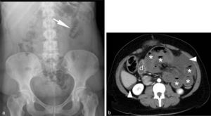 Fifty-six (56) year-old woman at the emergency room presenting with diffuse abdominal pain and no gas or fecal expulsion. During the examination she shows poor health with the presence of tachycardia and hypotension, abdominal silence and “loop mass” palpation. The AR (a) does not show any significant findings with the exception of flexure thickening in a jejunal loop located at the left superior quadrant (arrow). (b) Computed tomography (axial view) in portal stage (70sg) of the middle abdomen region showing jejunal loop distention with no wall enhancement due to hypoperfusion (*) [compare it with the adjacent duodenum (d)]. Perihepatic intraperitoneal liquid in between the loops (arrow-heads). Surgery confirmed the diagnosis of intestinal obstruction caused by bridles complicated with strangulation; 55cm of necrotic small intestine were resected.