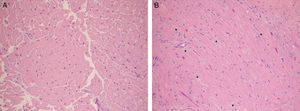 Two histologic samples colored with hematoxylin–eosin stain (increase 200×). (A) Normal myocardium with compact fiberts. (B) Transplanted heart patient with acute rejection where prominent interstitial edema can be seen (the myocardial fibers can be seen separated by a slighted blue material corresponding to the edema: stars).
