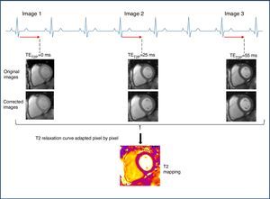 Data acquisition scheme and T2 mapping reconstruction. TrueFISP images prepared in T2 are acquired at intervals of at least 3 RR to allow the sufficient recovery of magnetization among the acquisitions. Each image is acquired in the same diastolic stage. An algorithm for the correction of movement is applied. Lastly the T2 relaxation curve is adapted pixel by pixel assuming one mono-exponential T2 relaxation signal. TET2P: time of preparation of T2.