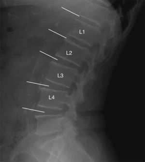 Lateral lumbar spine simple X-ray with images of calcifications in the abdominal aorta of one participant in the study. The partial scores in the ACC-24 scale (anterior wall+posterior wall) were: Level L1=1 (1+0), level L2=0, level L3=4 (3+1), level L4=2 (0+2) that is an overall score of 7.