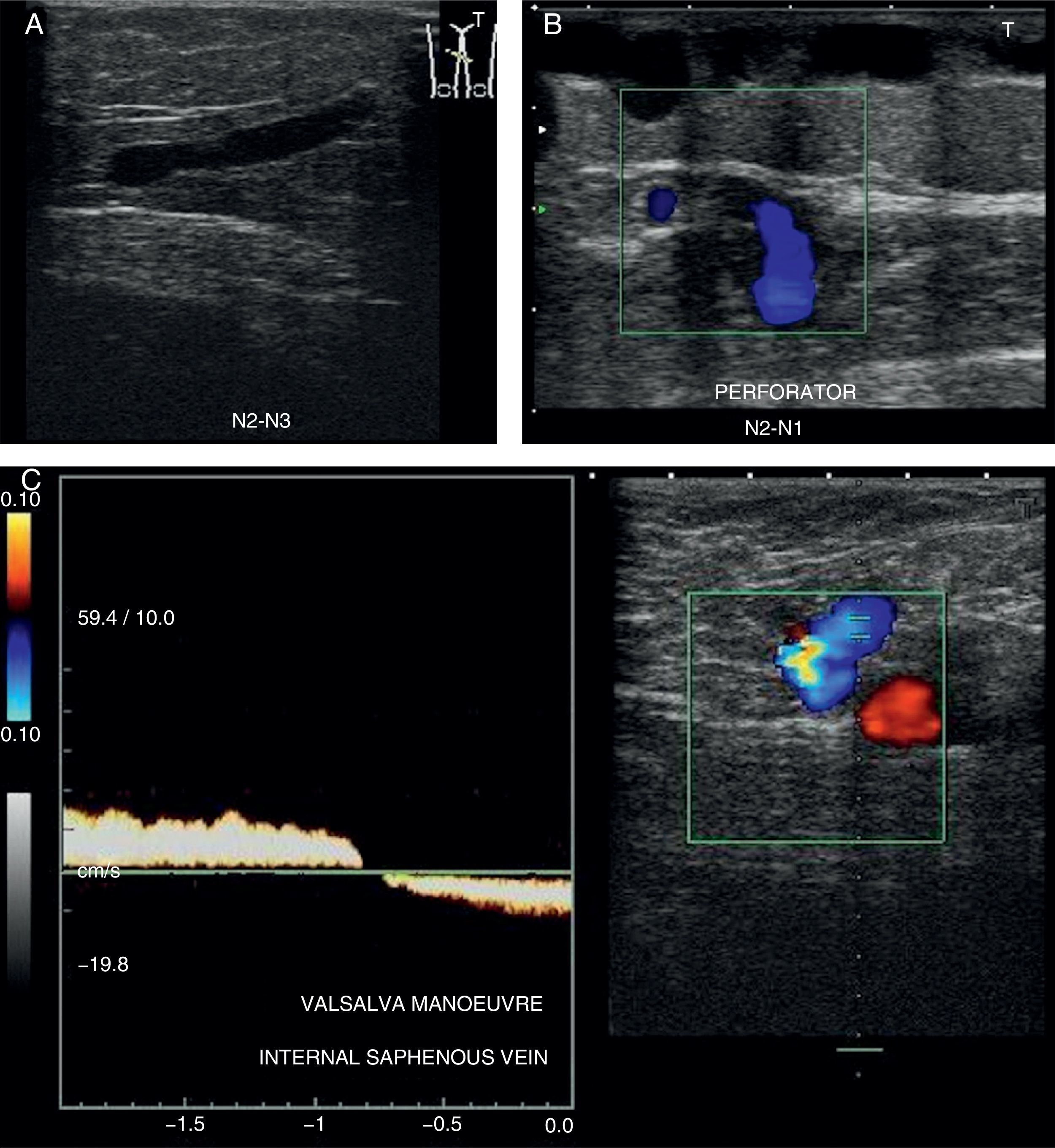 Doppler ultrasound study and venous mapping in chronic venous ...