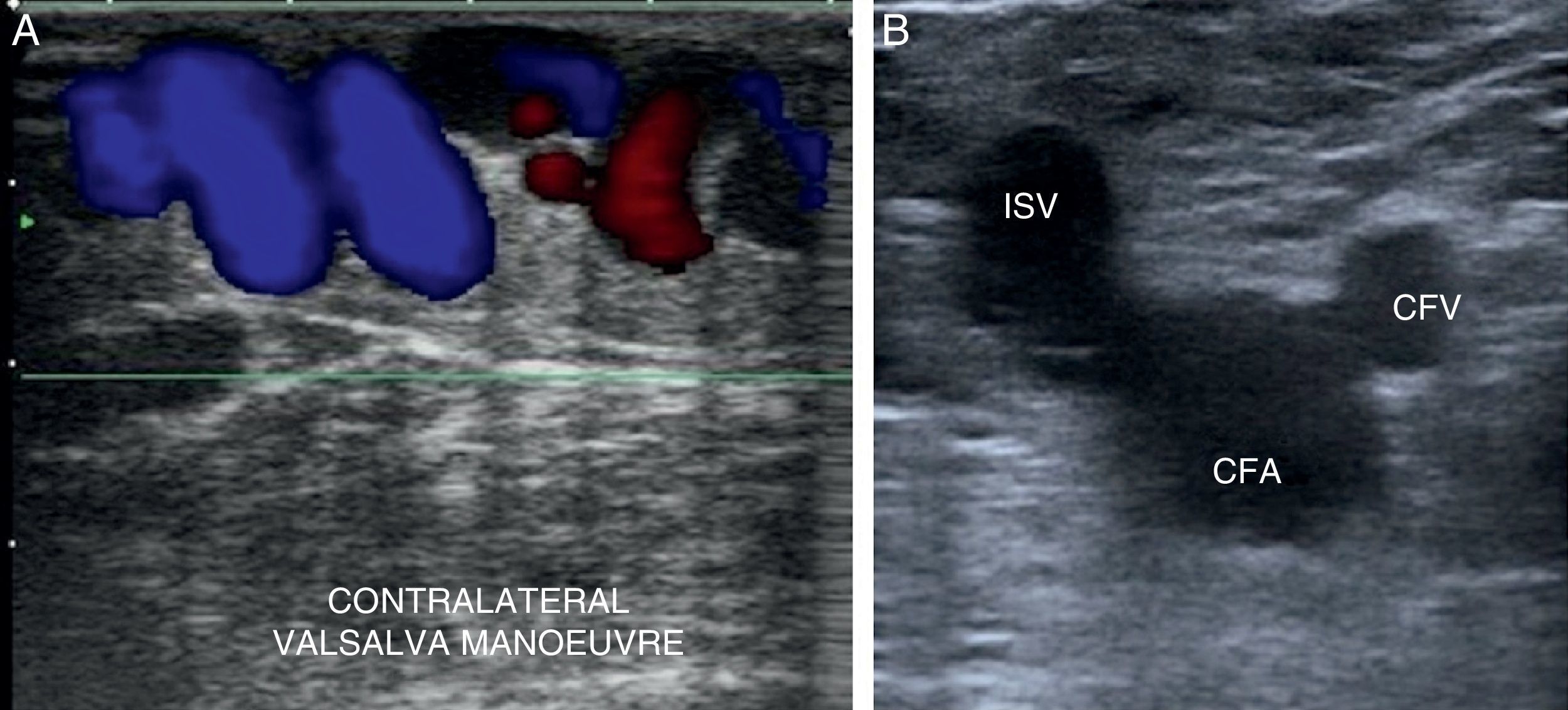 Gsv Waveforms Doppler ultrasound study and venous mapping in chronic venous ...