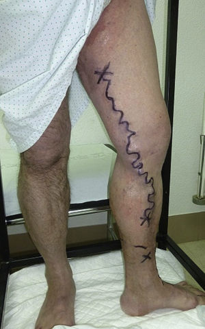 Presurgical marking.