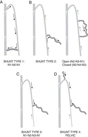 Types of shunts. (A) Type 1. (B) Type 2. (C) Type 3. (D) Type 4.