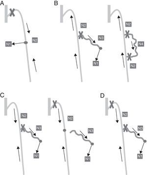 (A) CHIVA 1 in shunt Type 1. (B) CHIVA 1 in shunt Type 2. (C) CHIVA 2 in Type 3. (D) CHIVA 1+2.