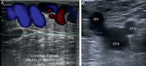 (A) Reflux with color Doppler (Valsalva maneuver). (B) Mickey Mouse sign. CFA: common femoral artery; CFV: common femoral vein; ISV: internal saphenous vein.