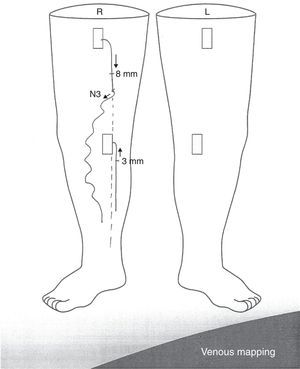 Example of shunt type 3 paper mapping.
