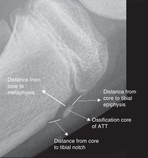 Lateral X-ray of the knee showing the assessed features: presence of ossification center secondary to the ATT, its distance to the epiphysis, metaphysis and tibial notch.