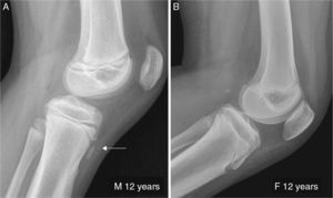 (A) Twelve year old boy in whom the ossification center has already initiated distal-to-proximal growth (arrow). (B) Twelve year old girl showing ossification center merge in its upper side into the tibial epyphysis.