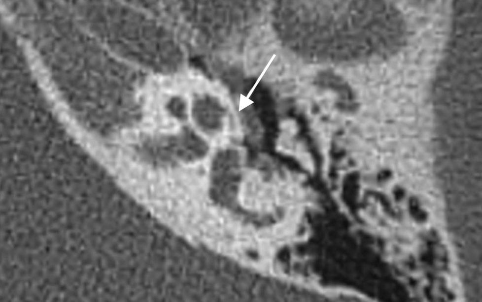 Cochlear Cleft Radiology Update on the imaging diagnosis of otosclerosis | Radiología (English ...
