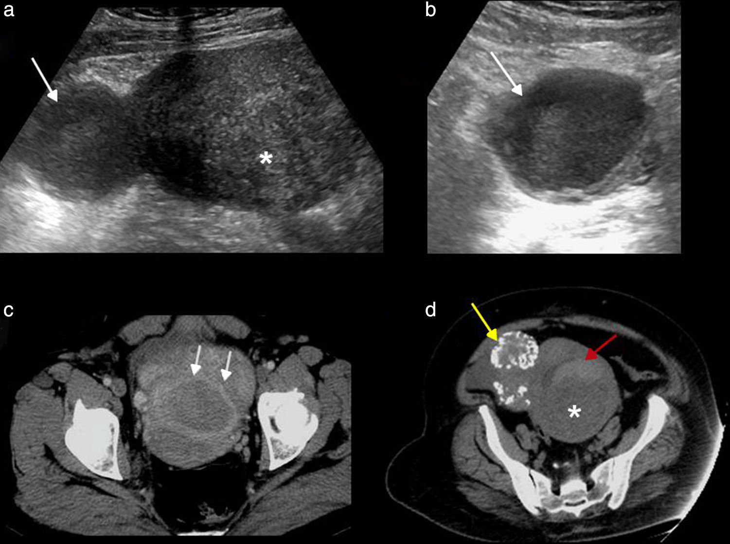 Gynecological pelvic pain as emergency pathology | Radiología (English ...
