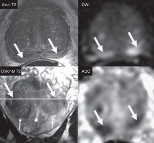 Selection of dominant sequence with respect to the anatomical area. Diffuse posterior Iso/hyposignal in axial T2-weighted sequence (arrows) with focal bilateral hypersignal in DWI (b=1400s/mm2) and hyposignal in ADC (arrows). The incorrect location of focalizations as peripheral areas would lead to the assessment of lesions in the DWI sequences (dominant sequence in the peripheral area), with PIRADS category 4. The findings are located in the central area, in the proximal posterior base of the gland. The coronal slice in T2 allows us to locate the reference slice of the axial plane (white line), the right area as the central area (glandular base), but not as peripheral area. Anatomically, the central area, in general, does not spread distally to the verumontarum (short arrow), posteriorly to the gland. The coronal slice allows us to assess the transition between the central area (thin arrows) and the posterior distal peripheral area. The correct location of the central area establishes the T2 sequence as the dominant one (and not DWI) - being the homogeneous isointense pattern normal in the T2 of the central area. The restriction of diffusion of the central area is physiological, showing a relatively symmetrical, bilateral appearance, described as mustache sign, due to its appearance on the axial plane in ADC or DWI (arrows).