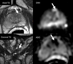 Reading of the multiparametric magnetic resonance imaging study. Visualization of the four sequences (axial, coronal T2, DWI [high b value] and ADC) in the same window for an effective assessment of morphology, signal and zonal localization of a PIRADS 4 type of lesion (arrow) in the left anterior transitional area. The optimal level of the window should be adjusted to visualize the image correctly both in DWI and on the ADC map.