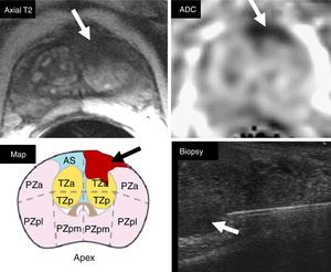 Cognitive topographic localization. The PIRADS category 5 lesion in the anterior transitional segment of the left apex shown in T2 and DWI (arrows) should be located in the sectorial grid of the topographic map together with the report (arrow). This information is essential to perform cognitive fusion during the ultrasound biopsy procedure, and thus be able to guide the needle to the suspicious segment (arrow) detected on the MP-MRI.