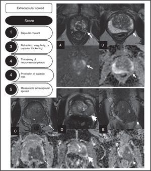 Description of the different types of local spread of prostate cancers defined by the European Society of Urogenital Radiology and their score. Examples of the different categories defined are shown. (A) Capsular contact, T2 and ADC sequences (arrows). (B) Retraction, irregularity of capsular thickening, T2 and ADC images (arrows). (C) Thickening of neurovascular plexus, T2 and ADC images (arrows). (D) Protrusion of the capsule, T2 and ADC images (arrows). (E) Measureable extracapsular spread, T2 and ADC sequences (arrows).