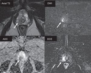 Patient who underwent systematic biopsy due prostate-specific antigen increase. Prostate cancer (PCa) with Gleason 3+3 is diagnosed affecting a small percentage of only one cylinder. Patient is eligible for active surveillance; multiparametric magnetic resonance imaging study is performed. A right apical area is identified in the peripheral area (arrows) with PIRADS category 4 (score 4 in DWI sequence [b=1400s/mm2]) suggesting Gleason ≥7. When the guided biopsy is performed, PCa with Gleason 4+4 is diagnosed affecting three cylinders in 30 per cent of sample tissue.