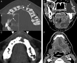 Abscesses of the oral cavity. Abscess in the oral vestibule space. (A) Computed tomography (CT) scan, axial cut reconstructed in bone window. (B) CT scan, sagittal reconstruction in bone window. (C) CT scan, axial cut reconstructed in soft tissues. Female with clinical manifestations of neuralgia and anterior facial tumefaction. The CT scan shows periodontal affectation in the premaxillary region (arrows in A and B), dental pieces #21 and #22–showing metallic material due to prior endodoncy–in the form of periapical abscess with phlegmonous affectation of the oral space and the vestibule (short arrows in C). Submandibular abscess. (D) CT scan, coronal cut with intravenous (IV) contrast. (E) CT, oblique axial reconstruction in bone window. (F) CT scan, axial with IV contrast. Sixty-two year old-male with left submandibular pain. In the CT scan there was one collection with peripheral enhancement (abscess) in the left mouth floor (asterisk in D and F). The infectious focus was located in dental piece #38 (arrow in E) showing one periapical abscess with dehiscence of the lingual cortex.