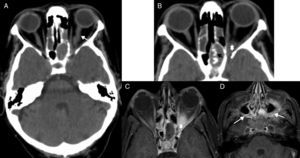 Orbital apex syndrome due to fungal sinusitis. (A) Computed tomography (CT) scan of the brain, axial cut. (B) CT scan of paranasal sinus structures, axial cut. (C and D) Magnetic resonance imaging (MRI), axial cut T1-weighted imaging with fat saturation after the administration of gadolinium. Patient presents to the ER with visual loss in left eye. One CT scan of the brain is performed (A) that confirms presence of an oversized optic nerve (arrow in A), complete opacification of the sphenoid sinus that showed thickened walls, very thick intrasinus calcifications (black arrow in B), and soft tissue increase in the apex (asterisk in B). Due to suspicion of invasive fungal sinusitis, one MRI is performed (C and D), that confirms soft tissue increase in the orbital apex (asterisk in C) and that the swelling has spread towards adjacent soft tissues (white arrows in D) in both pterygopalatine fossae.