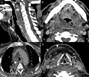 Necrotizing fasciitis. (A) Sagittal computed tomography (CT) with IV contrast. (B–D) Axial CT scan with IV contrast at different cervical levels. Seventy-four year old-patient who presents to the ER with clinical manifestations of dyspnoea, odynophagy, and fever. The patient is then referred to the ENT who confirms saturation levels at 87% and triage and retractions. The image shows thickening of the skin and the subcutaneous cellular tissue–celulitis (arrow in D), thickening and enhancement of superficial and deep fascias–fascitis (arrowhead in D), thickening and enhancement with fluid collections of prelaryngeal muscles–miositis (discontinuous arrow in D), swelling of the pharyngeal mucosal space (black arrows in B), and swelling of the whole retropharyngeal space (dashed line in A and B) spreading towards the mediastinum (asterisk in C). Also, there was presence of gas (curved arrow in D) and right pleural effusion (arrow in C).