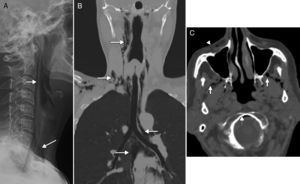 Spontaneous cervical emphysema. (A) Simple lateral X-ray. (B) Computed tomography (CT) scan with coronal reconstruction. (C) Axial CT scan. (A and B) Spontaneous neumomediastinum in one young patient who presents to the ER with clinical manifestations of retrosternal pain, sensation of dyspnoea, and odynophagy after choking. There is presence of cervical emphysema (arrows) spreading towards the mediastinum–a very recognizable finding in the simple X-ray. The CT scan was performed in order to distinguish it from Boerhave's syndrome. (C) CT scan of the brain of one patient with suspicion of stroke who is a carrier of one peripheral route. In the image there was presence of air in the masticator space (white arrows), in the anterior fascial vein (arrowhead), in the epidural space, in anterior portion of the foramen magnum (discontinuous arrows).