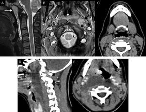 Infection of the retropharyngeal space. (A) Magnetic resonance imaging (MRI), sagittal cut T2-weighted imaging with fat saturation. (B) MRI, axial T2-weighted imaging. C) Computed tomography (CT) scan, axial cut. (D) CT scan, sagittal reconstruction after the administration of IV contrast. (E) CT scan, axial cut after the administration of IV contrast. (A–C) Female with cervical pain, fever, and odynophagia. In the MRI we saw hypertrophy of the mucosal space of pharyngeal tonsils–amigdalitis (white arrows in A and B), one left retropharyngeal adenitis (black arrow in B), and retropharyngeal swelling (celulitis) (dashed line in A and C). Swelling grows bilaterally in the retropharyngeal space and barely distends to space of a few millimetres. (D and E) Fifteen year old-female diagnosed with mononucleosis who presents with high fever, significant odynophagia, and trismus. The CT scan confirmed the presence of one asymmetric fluid collection with peripheral enhancement in the retropharyngeal space, suggestive of an abscess (dashed line arrow), that was confirmed after aspiration and drainage.