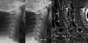 Spondylodiscitis. (A and B) Lateral X-ray of the spine. (C) Magnetic resonance imaging (MRI), T2-weighted sagittal cut. (D) MRI, T1-weighted sagittal cut enhanced with gadolinium. (E and F) MRI, T1-weighted axial cuts enhanced with gadolinium at C2 level (E) and C6 level (F). Patient presents with neck pain and undergoes ones lateral X-ray (A). The X-ray shows reduction of intervertebral spaces and mild erosion of C5–C6 and C6–C7 discs that is interpreted as degenerative changes. Twelve (12) days later the patient presents to the hospital with more intense pain. Another X-ray is performed (B) that confirms clear progression with loss of height in vertebral bodies C5 and C6 and greater enhancement of pre-vertebral space (double arrow in B). Since spondylodiscitis was suspected, one MRI is performed that confirms such condition as well as the existence of one pre-vertebral collection (long arrows in C) with intense enhancement after the administration of gadolinium (arrowheads in D and F). There was also one collection in the epidural space (dashed line in D). In the location of greater affectation, that is segment C5–C6, there was an oversized pre-vertebral musculature with increased uptake (black curved arrows in F) that was not present in upper levels like C2 (white curved arrows in E).