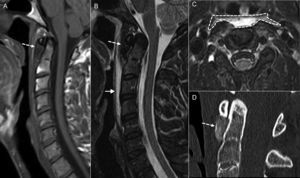 Calcific tendonitis of the longus colli. (A) Magnetic resonance imaging (MRI), sagittal cut T1-weighted imaging. (B) MRI, sagittal cut T2-weighted imaging. (C) MRI, axial cut T2-weighted imaging with fat saturation. (D) Computed tomography (CT) scan, sagittal reconstruction in bone window. Patient presents with neck pain. One MRI was performed that confirmed pre-vertebral space swelling (arrow in B and dashed silhouette in C). Also, there was significant hyposignal anterior to the odontoid apophysis (dashed arrow in A and B) that in the CT scan was confirmed as a deposit of calcium (dashed arrow in D).