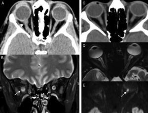 Optic neuritis. (A) Computed tomography (CT) scan of the brain, axial cut. (B) Magnetic resonance imaging (MRI), coronal cut, T2-weighted imaging with fat saturation. Twenty-three year old-female who presents to the hospital with visual loss and pain in her right eye. The CT scan confirms an increased calibre of the optic nerve (arrow in A). The MRI better defines oversized optic nerves showing hypersignal and poor definition of bulbar covers (arrow in B). Acute ischaemic optic neuritis. (C) CT scan of the brain, axial cut. (D) MRI, axial cut T2-weighted imaging with fat saturation. (E) MRI, axial cut diffusion-weighted imaging. Sixty-two year old patient presents to the ER with visual loss in left eye. The CT scan of the brain did not show any significant alterations at encephalic parenchyma or orbital levels. In the MRI, the optic nerve showed normal thickness and definition. The diffusion-weighted imaging, however, showed hypersignal in the left optic nerve papilla (arrow in E).