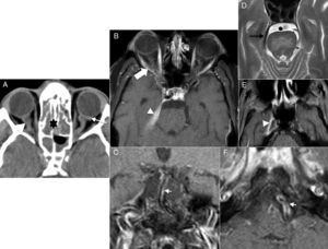 Orbital idiopathic inflammatory disease due to giant cell arteritis. (A) Computed tomography (CT) scan of the brain, axial cut. (B, E and F) Magnetic resonance imaging (MRI), axial cut T1-weighted imaging with fat saturation after the administration of gadolinium. (C) MRI, coronal cut T1-weighted imaging with fat saturation after the administration of gadolinium. (D) MRI, axial cut T2-weighted imaging. Sixty eight year old patient (A) who presents to the hospital with visual loss in left eye and diagnosed with acute ischaemic optic neuritis. In the CT scan there was presence of thickening in both optic nerves (short arrow in A) and bulbar covers (long arrow in A). Yet despite the fact that nor the clinical data or the biopsies were not conclusive, giant cell arteritis was diagnosed and with this suspicion in mind it was treated with corticoids. Four (4) months later the patient presents to the hospital again (B–F) with new clinical manifestations in the right eye. One PET (positron emission tomography) scan is performed (not shown) that confirms Meckel's cave and right orbital vertex uptake. The MRI confirms orbital vertex affectation (thick arrow in B) and shows thickening and hyper-uptake of Meckel's cave dura mater (arrowhead in E) and right petroclinoid ligament (arrowhead in B), the latter being hypointense in the T2-weighted imaging (black arrow in D). Also, there was thickening and hyper-uptake of the basilar and vertebral arterial wall (arrows in C and F).