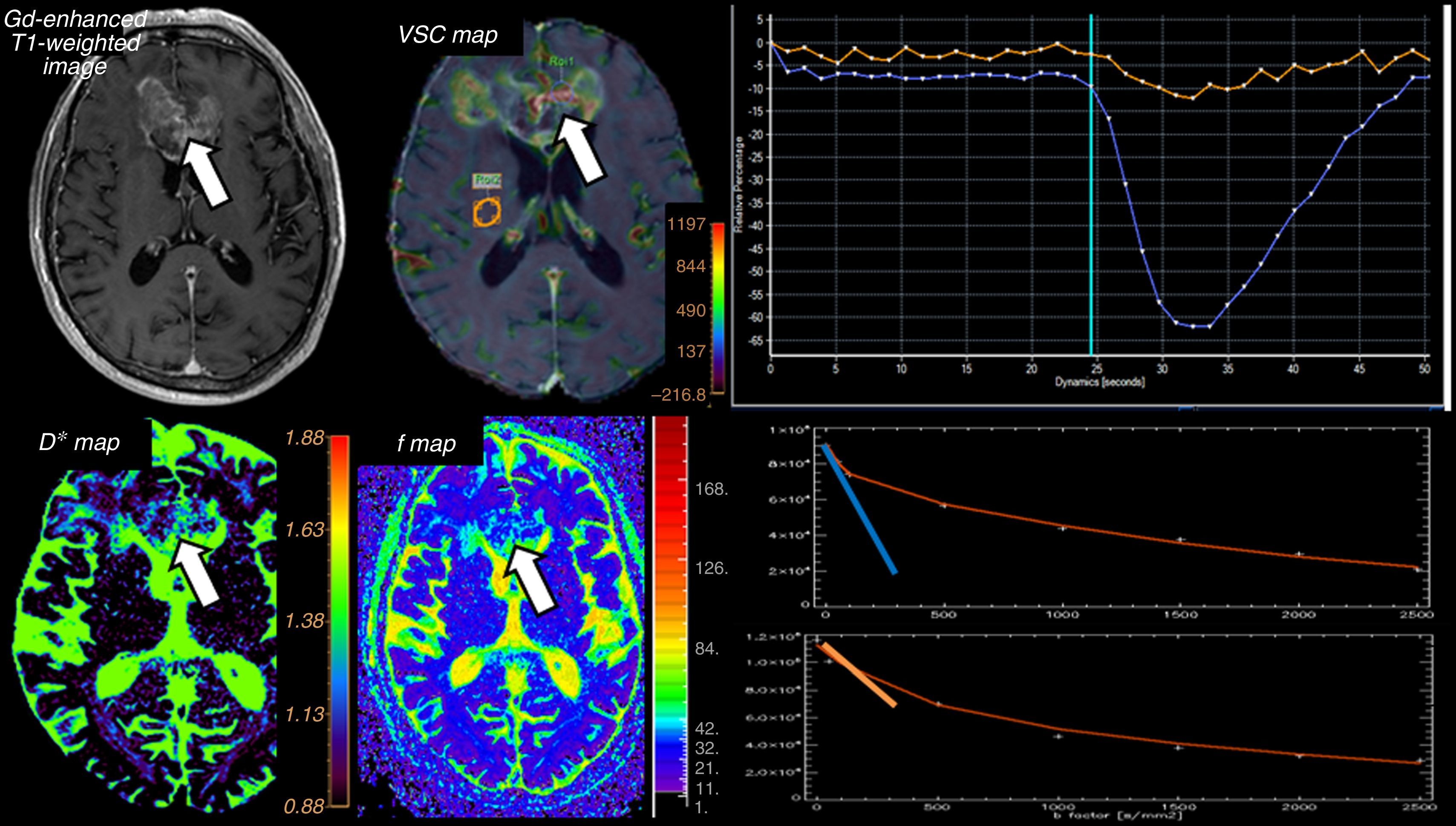 Advanced diffusion MRI and biomarkers in the central nervous system: A ...