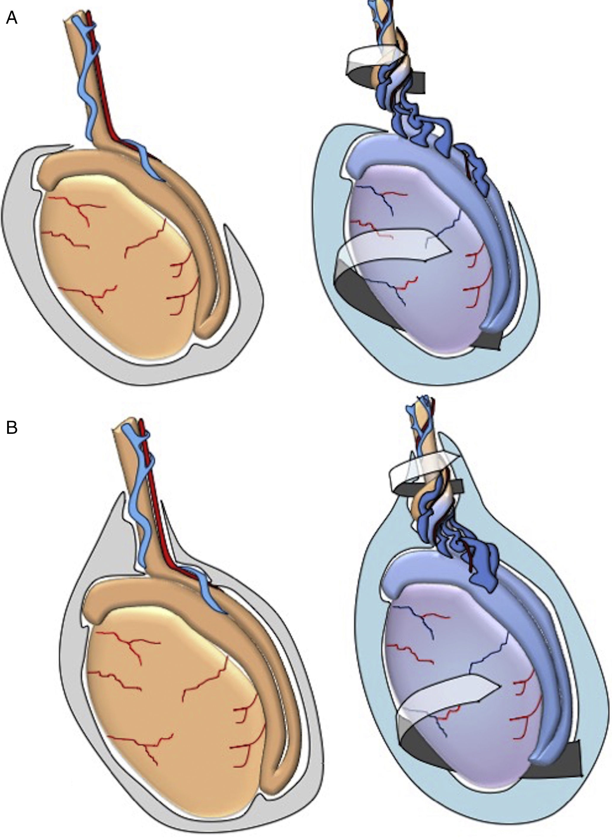 Perinatal testicular torsion: Ultrasound assessment and differential ...
