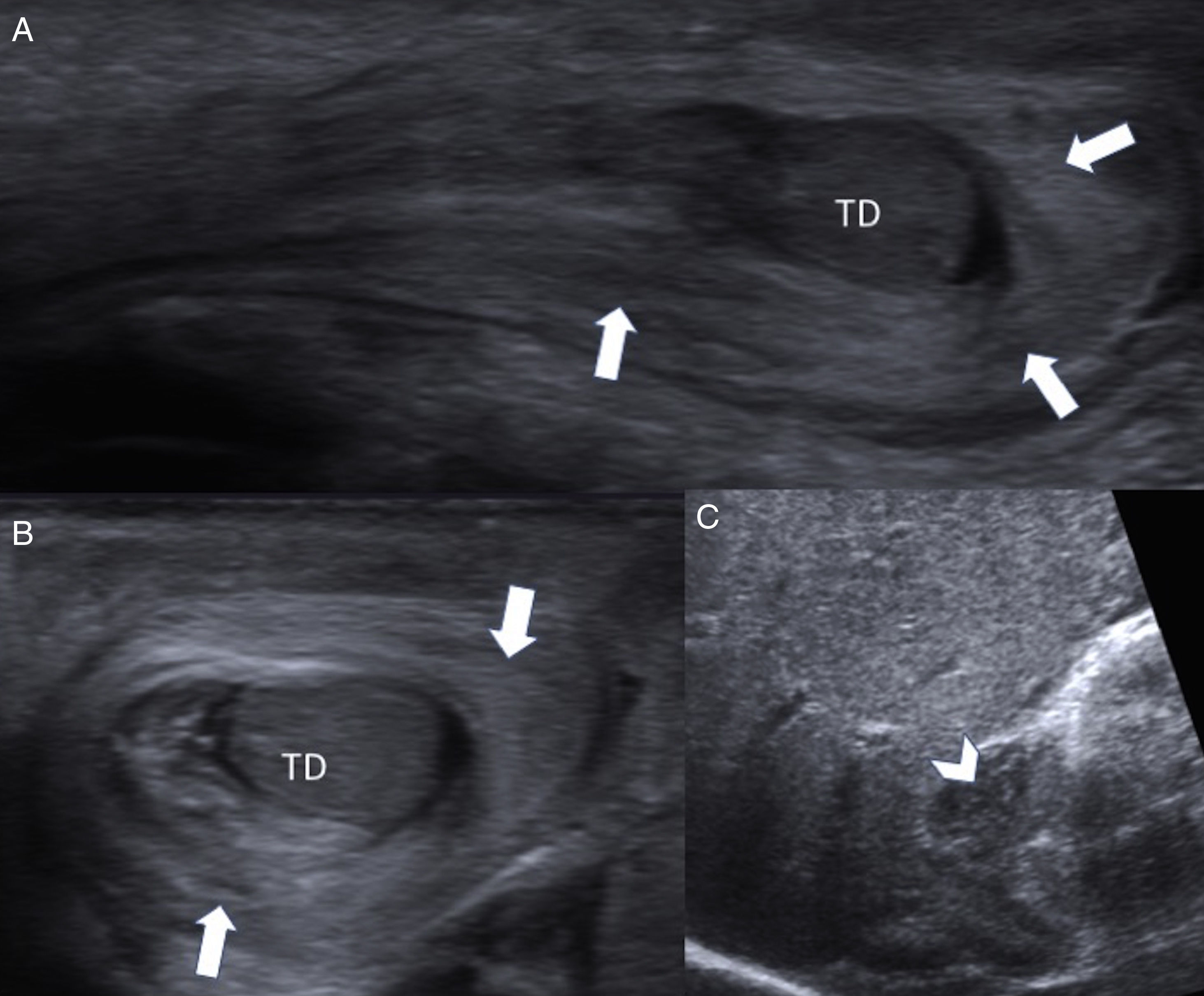 Infant Testes Perinatal testicular torsion: Ultrasound assessment and differential ...